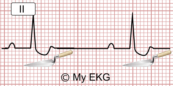 Eletrocardiograma em colher-de-pedreiro